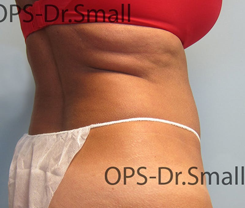 Liposuction Before & After Gallery - Patient 292276 - Image 10