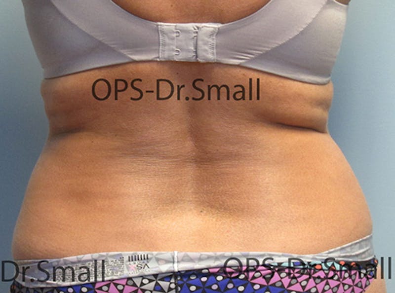 Liposuction Before & After Gallery - Patient 292276 - Image 11