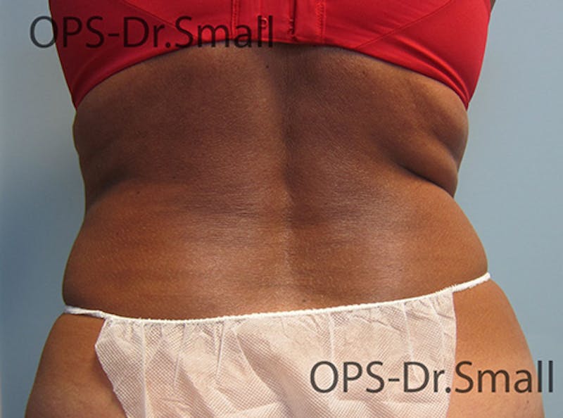 Liposuction Before & After Gallery - Patient 292276 - Image 12