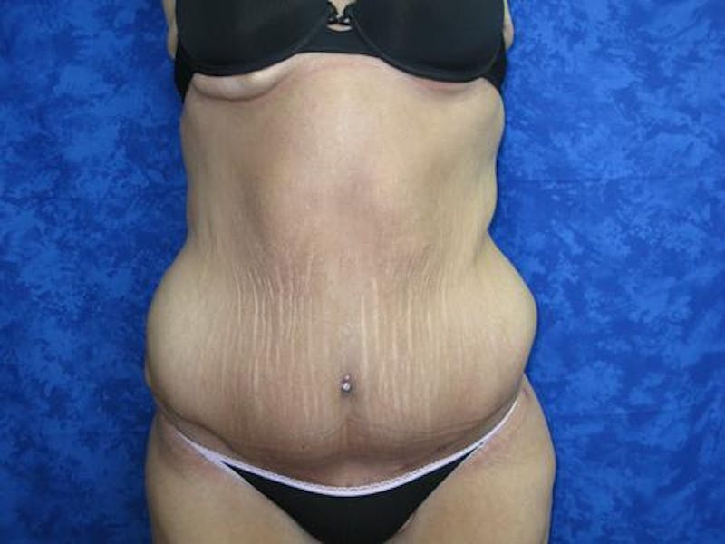 Body Reconstructive Before & After Gallery - Patient 329340 - Image 2