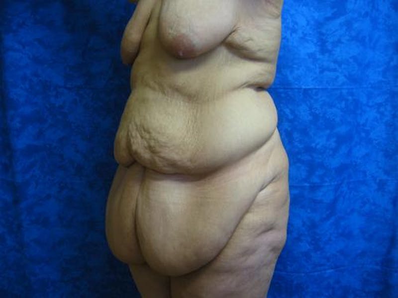 Body Reconstructive Before & After Gallery - Patient 329340 - Image 3