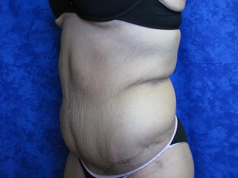 Body Reconstructive Before & After Gallery - Patient 329340 - Image 4