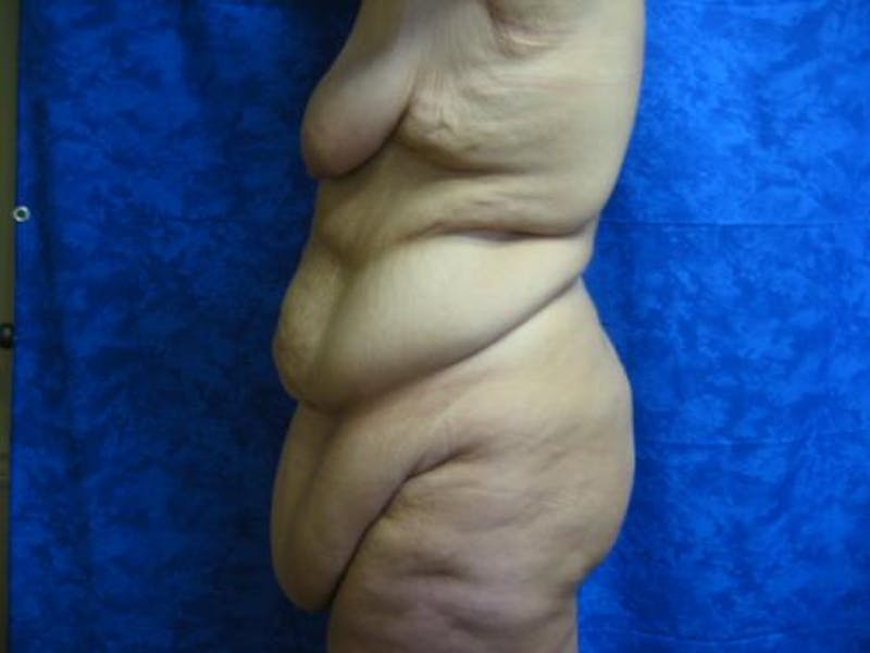 Body Reconstructive Before & After Gallery - Patient 329340 - Image 5