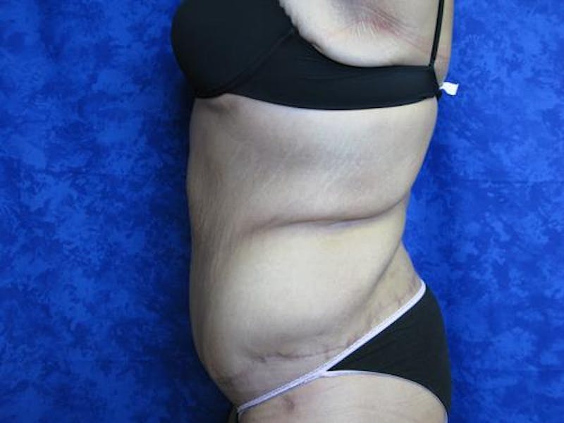 Body Reconstructive Before & After Gallery - Patient 329340 - Image 6