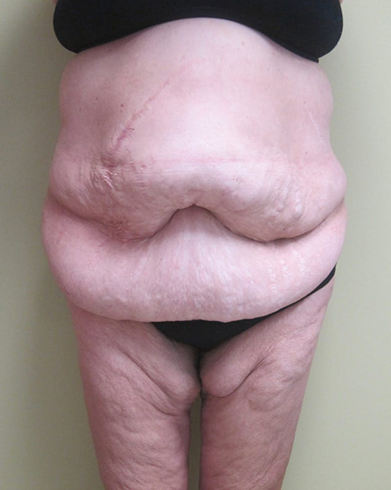 Body Reconstructive Before & After Gallery - Patient 135689 - Image 1