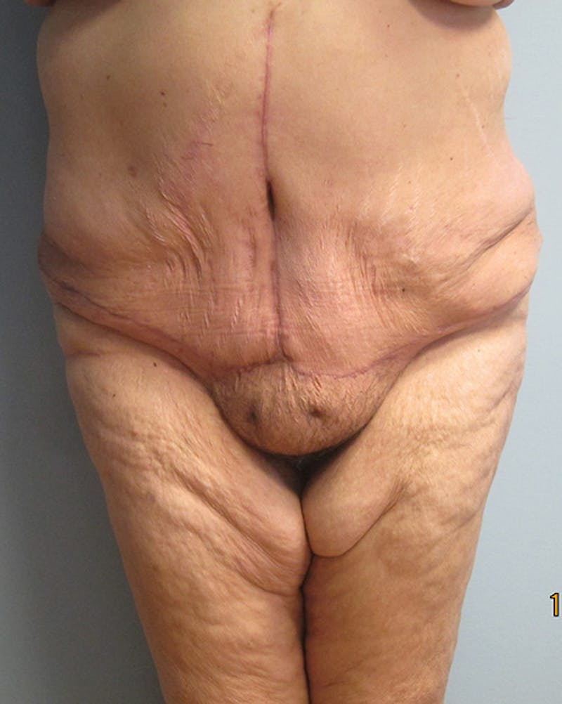 Body Reconstructive Before & After Gallery - Patient 135689 - Image 2