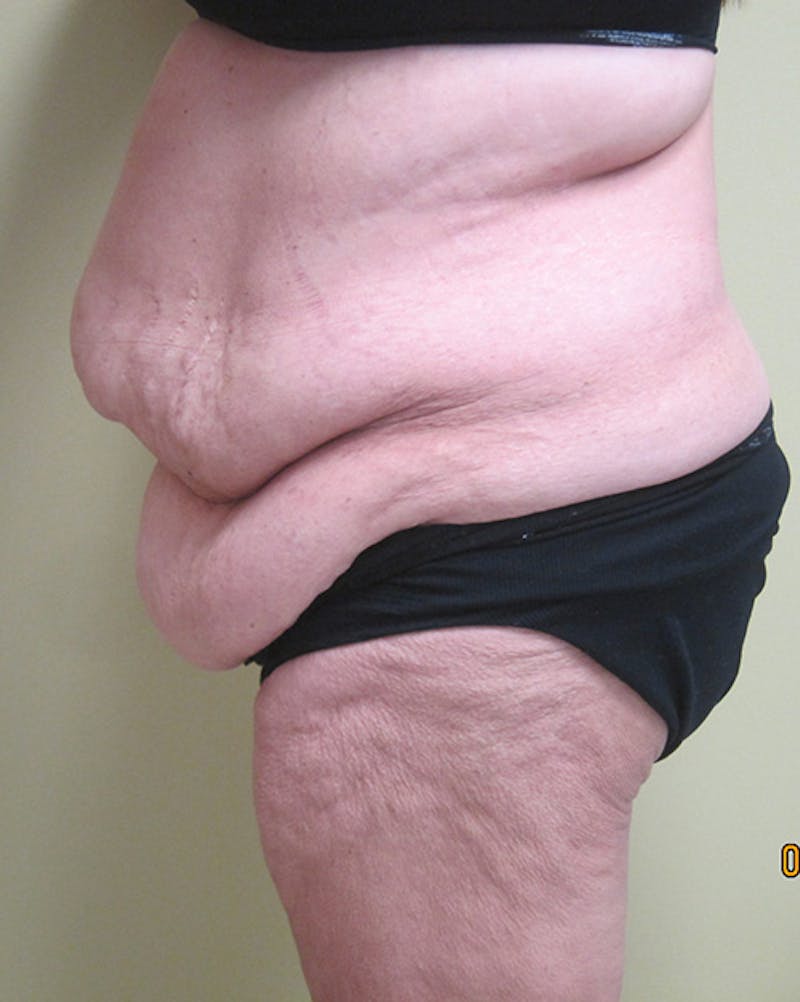 Body Reconstructive Before & After Gallery - Patient 135689 - Image 3
