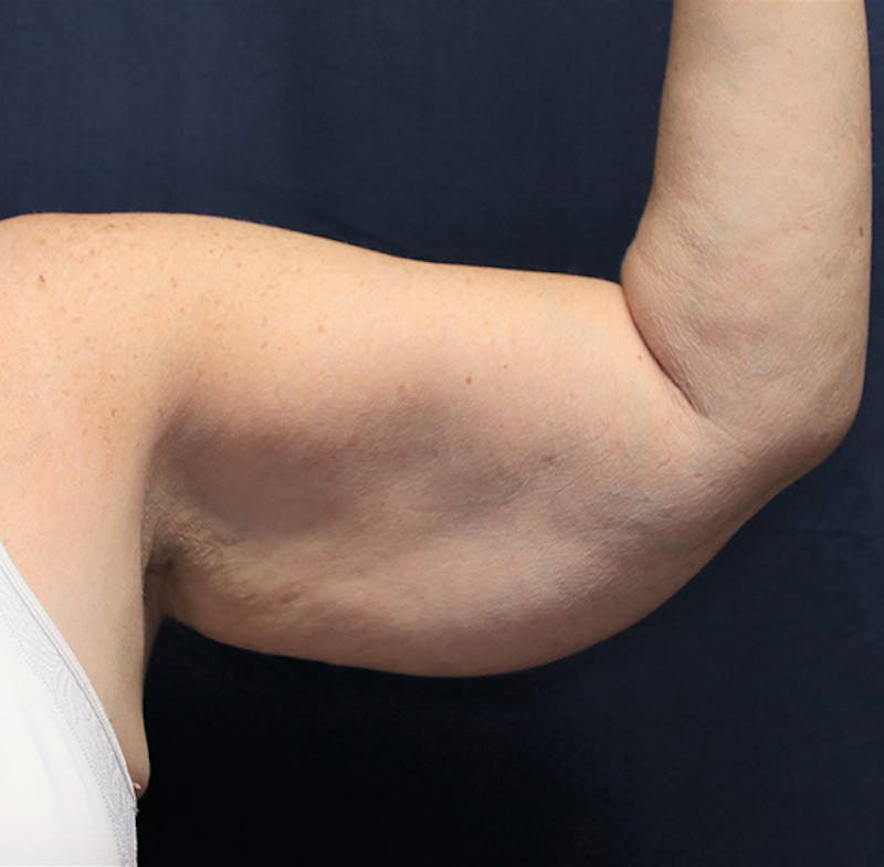 Brachioplasty (Arm Lift) Before & After Gallery - Patient 380278 - Image 1