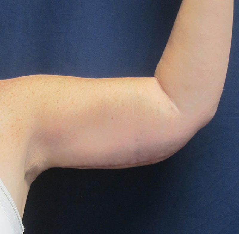 Brachioplasty (Arm Lift) Before & After Gallery - Patient 380278 - Image 2