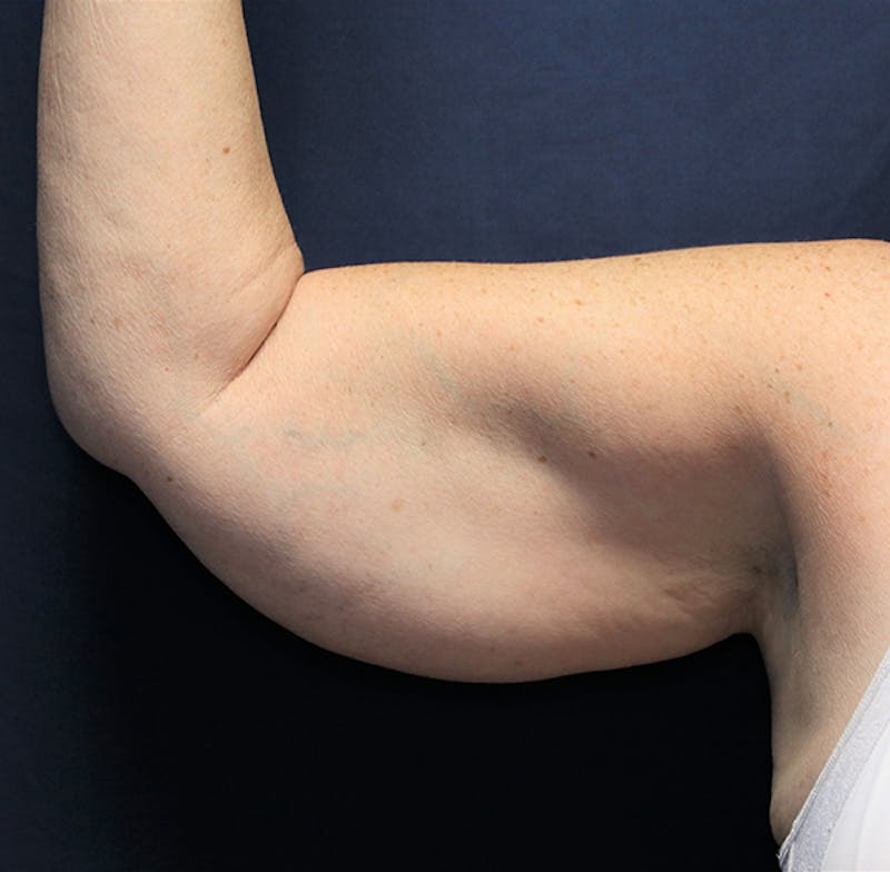 Brachioplasty (Arm Lift) Before & After Gallery - Patient 380278 - Image 3