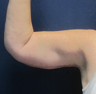 Brachioplasty (Arm Lift) Before & After Gallery - Patient 380278 - Image 4