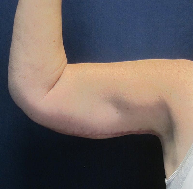 Brachioplasty (Arm Lift) Before & After Gallery - Patient 380278 - Image 4