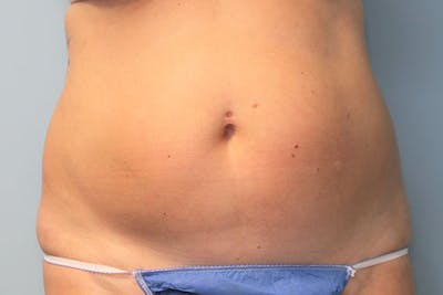 Liposuction Before & After Gallery - Patient 146898 - Image 1