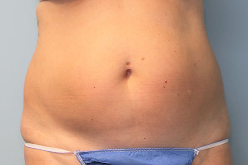 Liposuction Before & After Gallery - Patient 146898 - Image 1
