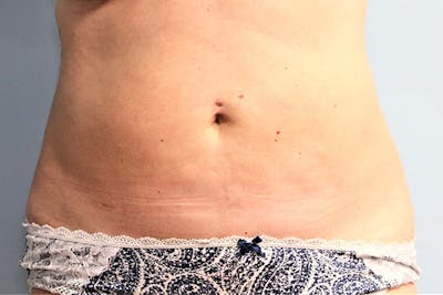 Liposuction Before & After Gallery - Patient 146898 - Image 2