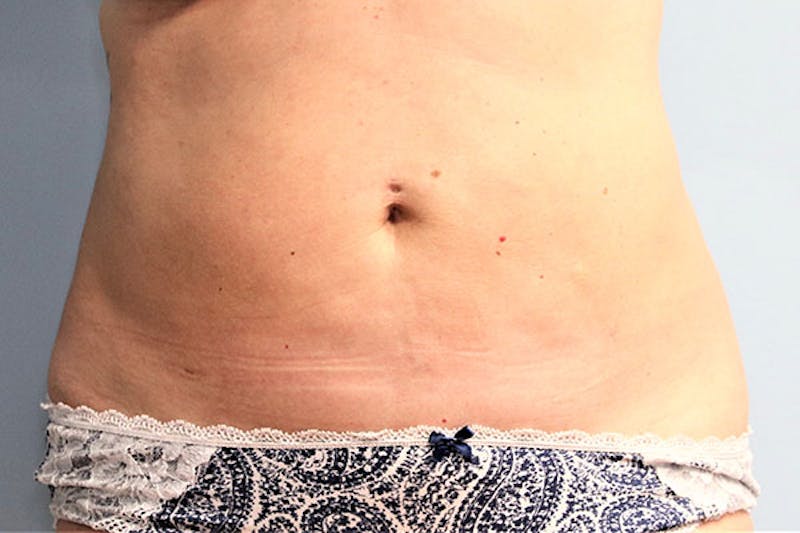 Liposuction Before & After Gallery - Patient 146898 - Image 2