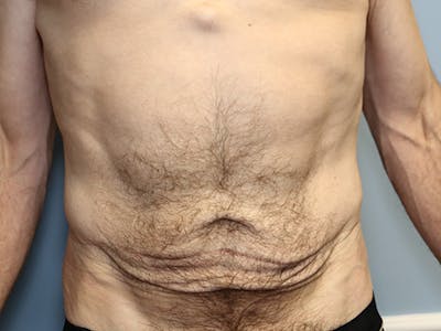 Abdominoplasty/Tummy Tuck Before & After Gallery - Patient 296016 - Image 1