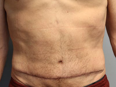 Abdominoplasty/Tummy Tuck Before & After Gallery - Patient 296016 - Image 2