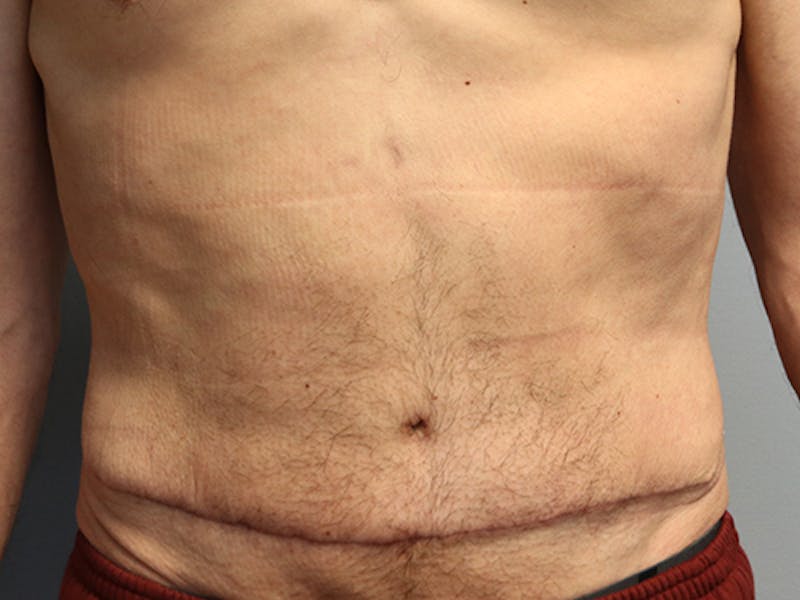 Abdominoplasty/Tummy Tuck Before & After Gallery - Patient 296016 - Image 2
