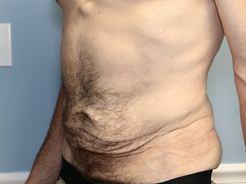 Abdominoplasty/Tummy Tuck Before & After Gallery - Patient 296016 - Image 3