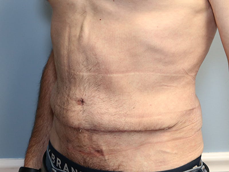 Abdominoplasty/Tummy Tuck Before & After Gallery - Patient 296016 - Image 4
