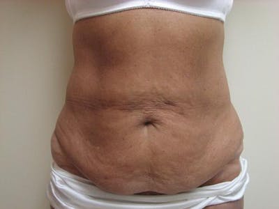 Abdominoplasty/Tummy Tuck Before & After Gallery - Patient 562622 - Image 1