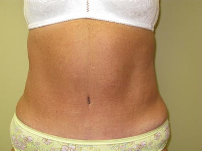 Abdominoplasty/Tummy Tuck Before & After Gallery - Patient 562622 - Image 2