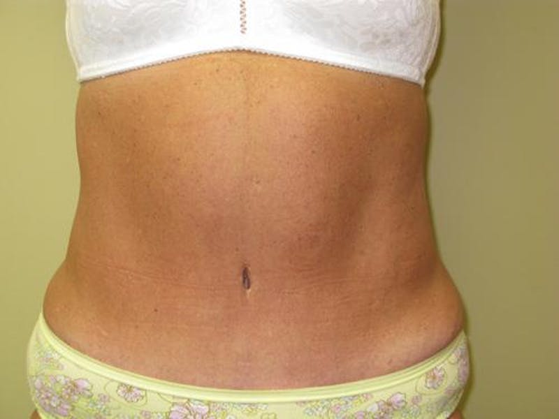 Abdominoplasty/Tummy Tuck Before & After Gallery - Patient 562622 - Image 2