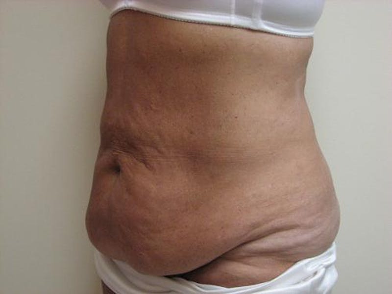 Abdominoplasty/Tummy Tuck Before & After Gallery - Patient 562622 - Image 3