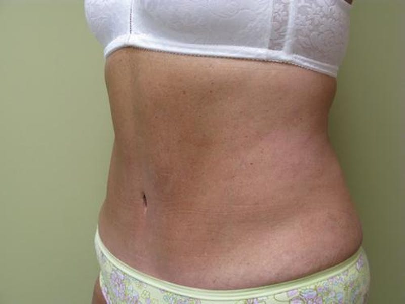 Abdominoplasty/Tummy Tuck Before & After Gallery - Patient 562622 - Image 4