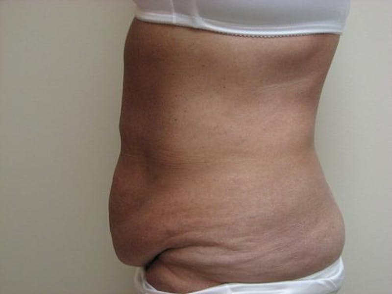 Abdominoplasty/Tummy Tuck Before & After Gallery - Patient 562622 - Image 5