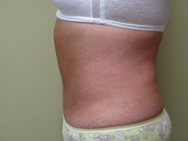 Abdominoplasty/Tummy Tuck Before & After Gallery - Patient 562622 - Image 6