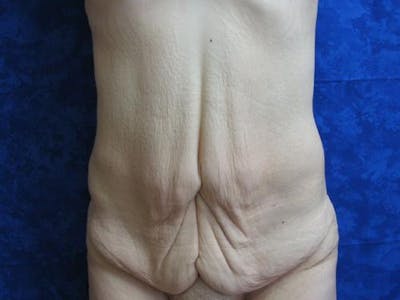 Abdominoplasty/Tummy Tuck Before & After Gallery - Patient 409785 - Image 1