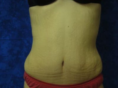 Abdominoplasty/Tummy Tuck Before & After Gallery - Patient 409785 - Image 2