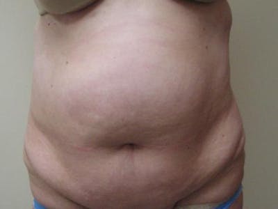 Abdominoplasty/Tummy Tuck Before & After Gallery - Patient 865322 - Image 1
