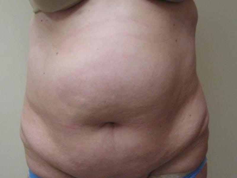 Abdominoplasty/Tummy Tuck Before & After Gallery - Patient 865322 - Image 1