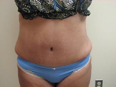 Abdominoplasty/Tummy Tuck Before & After Gallery - Patient 865322 - Image 2