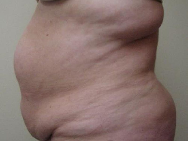 Abdominoplasty/Tummy Tuck Before & After Gallery - Patient 865322 - Image 3