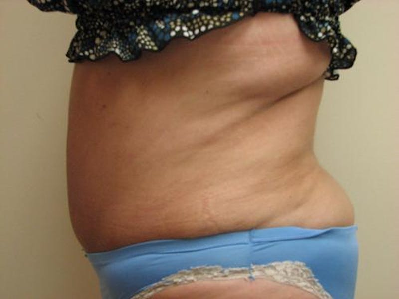 Abdominoplasty/Tummy Tuck Before & After Gallery - Patient 865322 - Image 4