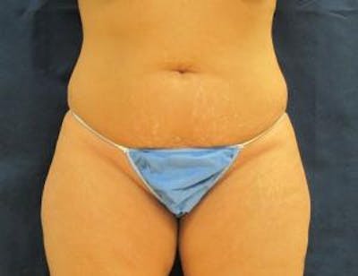 Abdominoplasty/Tummy Tuck Before & After Gallery - Patient 245829 - Image 1