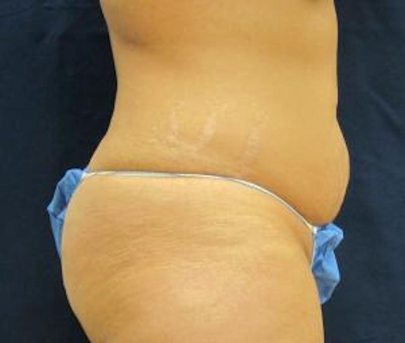 Abdominoplasty/Tummy Tuck Before & After Gallery - Patient 245829 - Image 3