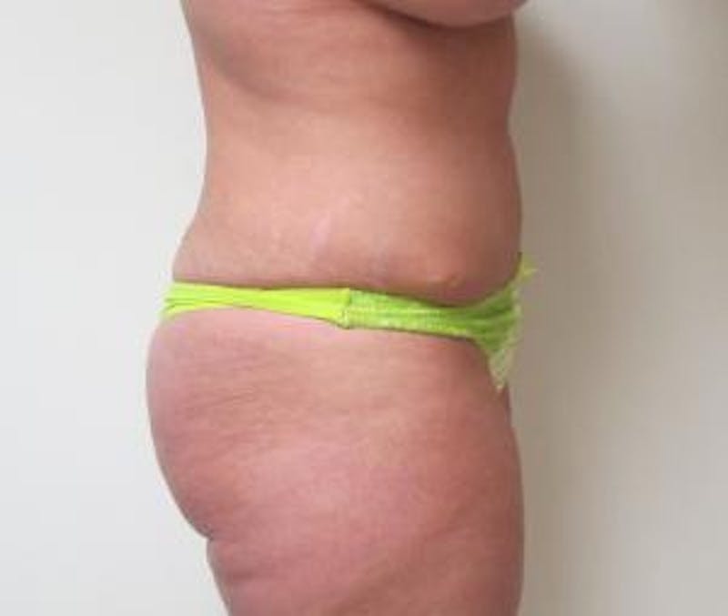 Abdominoplasty/Tummy Tuck Before & After Gallery - Patient 245829 - Image 4