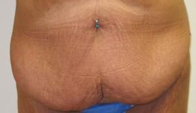 Abdominoplasty/Tummy Tuck Before & After Gallery - Patient 265901 - Image 1