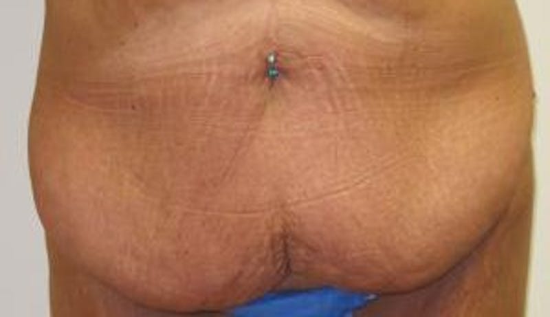Abdominoplasty/Tummy Tuck Before & After Gallery - Patient 265901 - Image 1