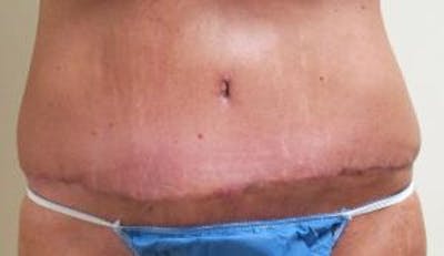 Abdominoplasty/Tummy Tuck Before & After Gallery - Patient 265901 - Image 2
