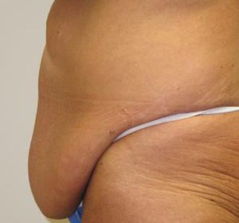 Abdominoplasty/Tummy Tuck Before & After Gallery - Patient 265901 - Image 3