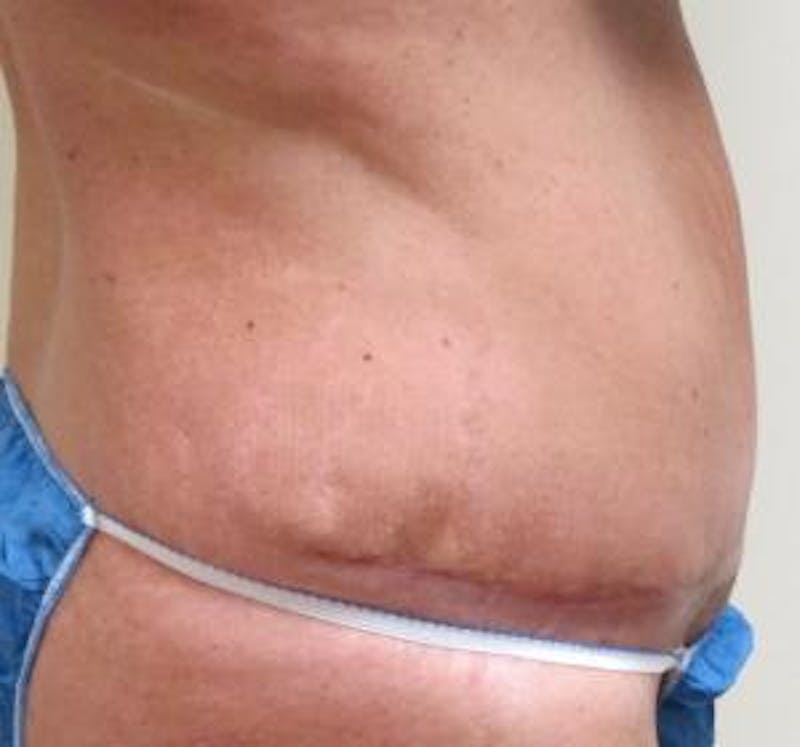 Abdominoplasty/Tummy Tuck Before & After Gallery - Patient 265901 - Image 4