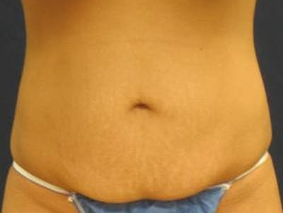 Abdominoplasty/Tummy Tuck Before & After Gallery - Patient 449533 - Image 1