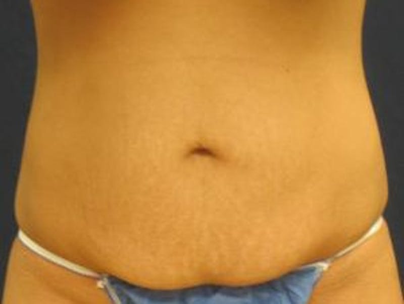 Abdominoplasty/Tummy Tuck Before & After Gallery - Patient 449533 - Image 1