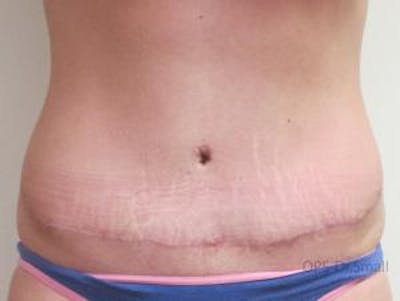 Abdominoplasty/Tummy Tuck Before & After Gallery - Patient 449533 - Image 2